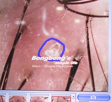 현미경으로 본 두피 모공