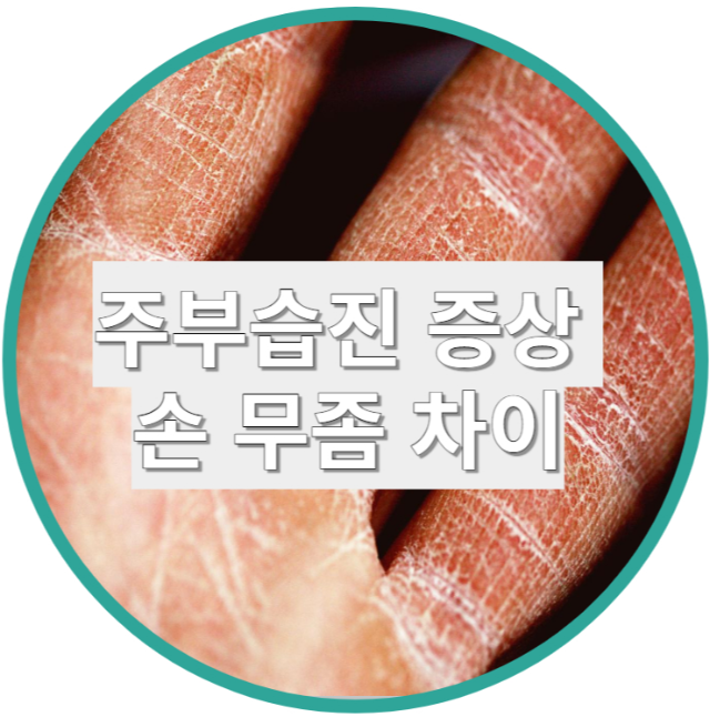 주부습진 증상