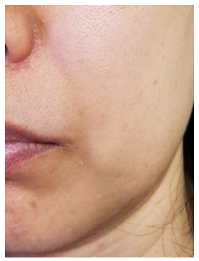 인모드fx 시술 직후