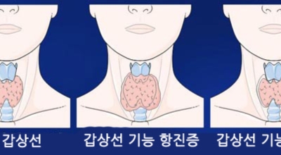 갑상선 이미지