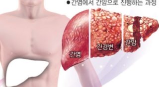 간경화 초기증상