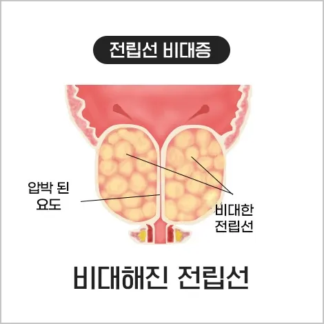 비대해진 전립선 (전립선비대증)