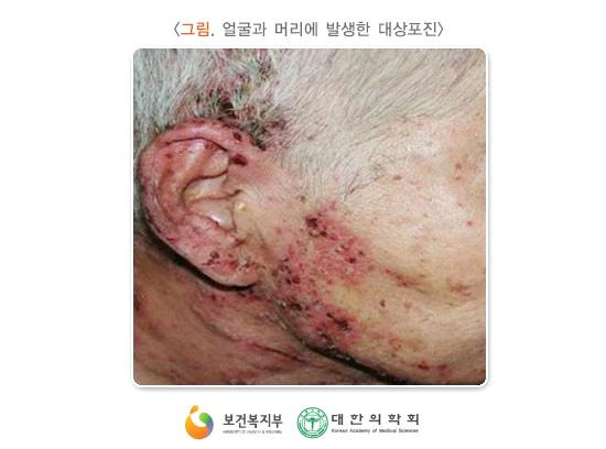 대상포진 원인부터 증상·치료·예방까지