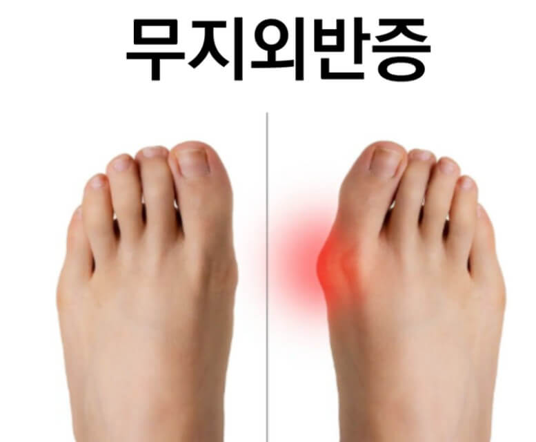 무지외반증인 사람과 아닌 사람의 차이