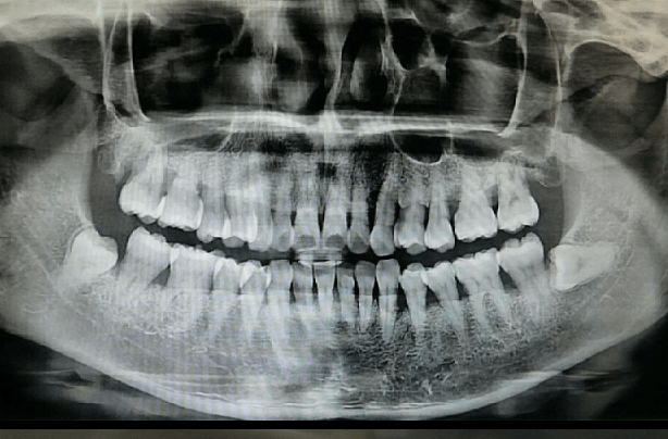 치아 치주염 관리방법