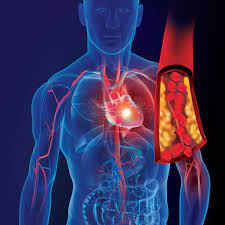 심근경색 전조증상