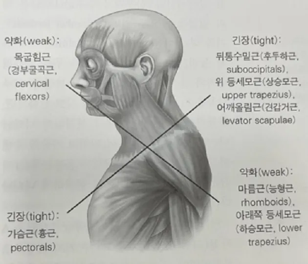 상부교차증후군