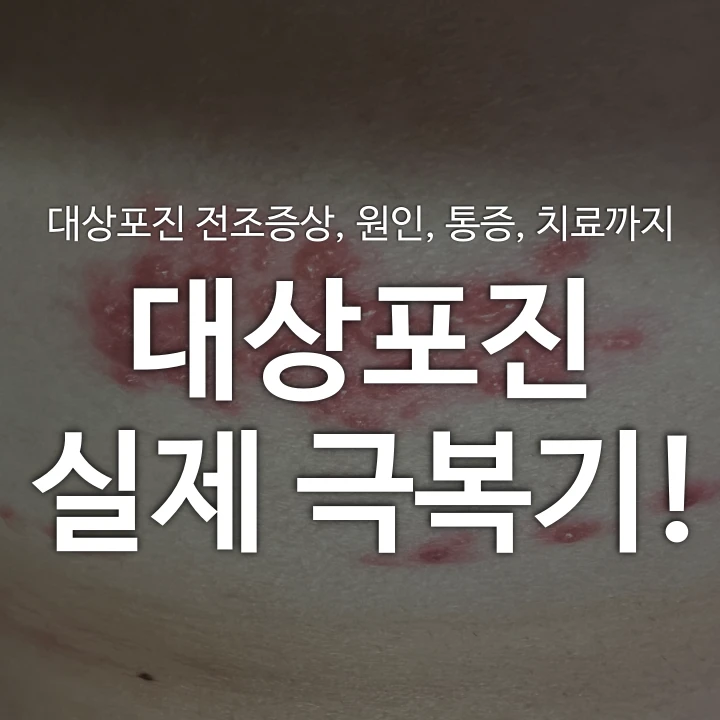 대상포진-실제-극복기