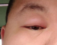 약국에서 눈 다래끼 빨리 낫는 법 : 형개연교탕 + 항생제 안약