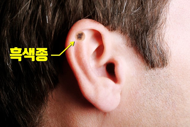 귀 선크림 썬크림 추천,눈시림 없는 선크림, 피부암,흑색종 증상,건강,팁줌 매일꿀정보