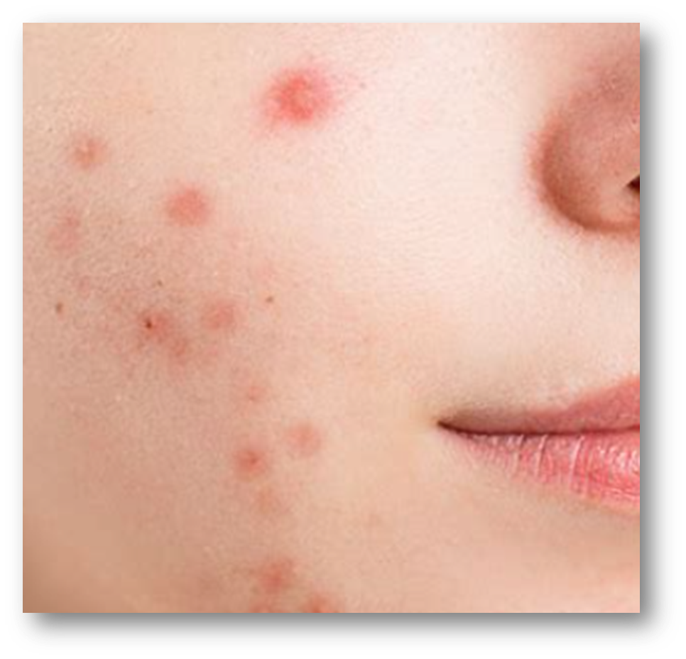  대상포진 초기증상3