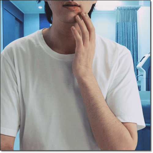 헤르페스성 구내염