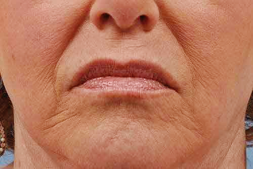 깊은 팔자주름