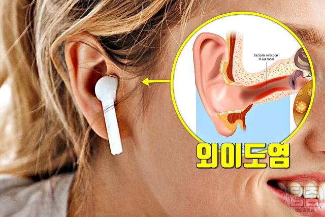 귀에서 삐소리 이명 증상 원인 외이도염