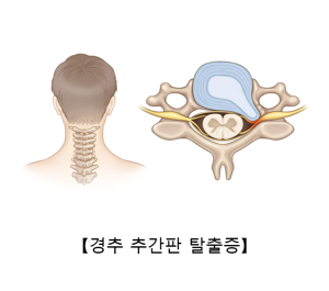 경추통증