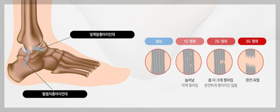 발목염좌손상정도