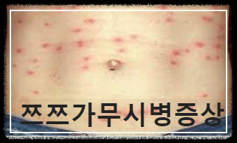 쯔쯔가무시병의 증상과 치료