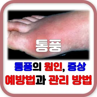 발가락 통풍 증상 및 대처방법_8