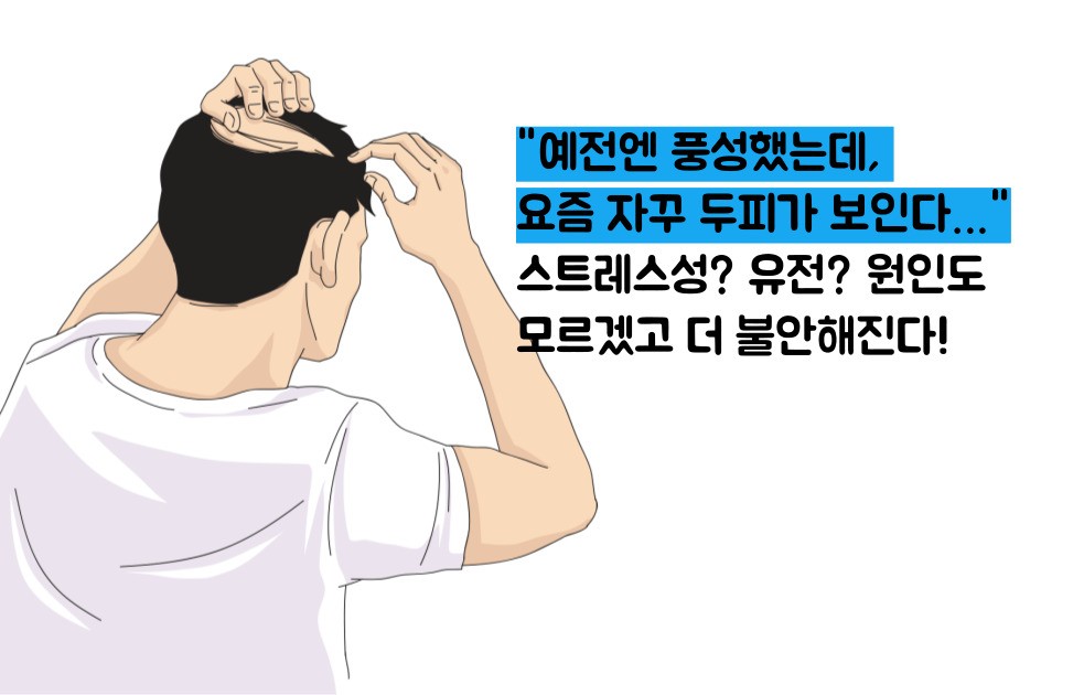 정수리 탈모