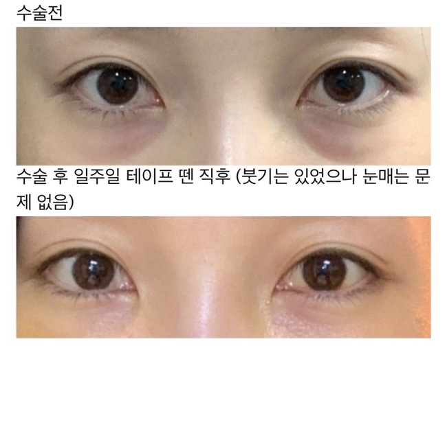 눈밑지방재배치 후기