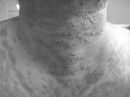 급성 전신성 발진성 농포증(AGEP)