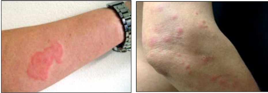 빈대에 물린 자국