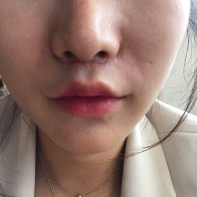 인중 축소 수술 후기