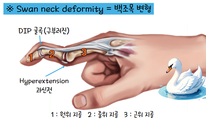 손가락 백조목 변형 사진