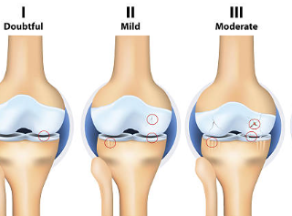 류마티스 관절염