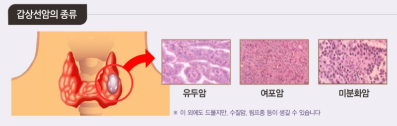 갑상선 결절 증상 및 원인과 치료 기능 저하증 수술 물혹 크기 모양 목에 혹