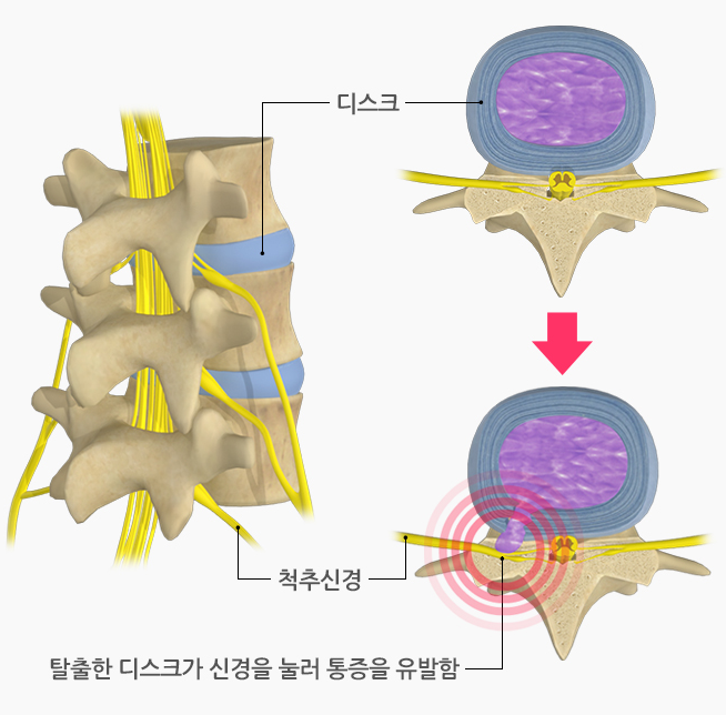 추간판 장애(디스크)