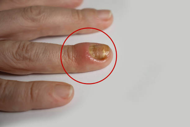 조갑주위염, 손톱염증을 일으키는 거스러미를 아시나요? 나도 모르게 항상 입으로 손을 뜯고 있는 나를 발견하는데요. 절대로 하지 말아야 할 행동입니다. 아무 생각없이 뜯고 있으면 피까지 나올 때가 있습니다. 왜 생기고 어떻게 예방을 해야 하는 걸까요?