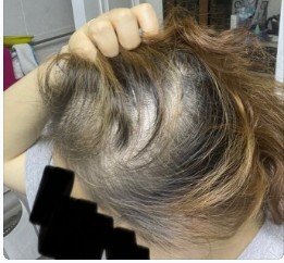 탈모지원금-설명사진