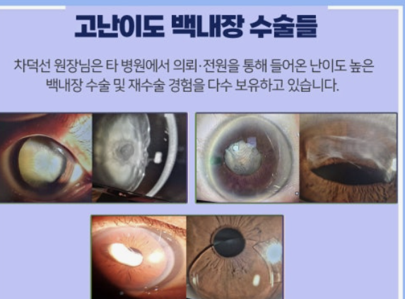 백내장 원인과 치료방법 