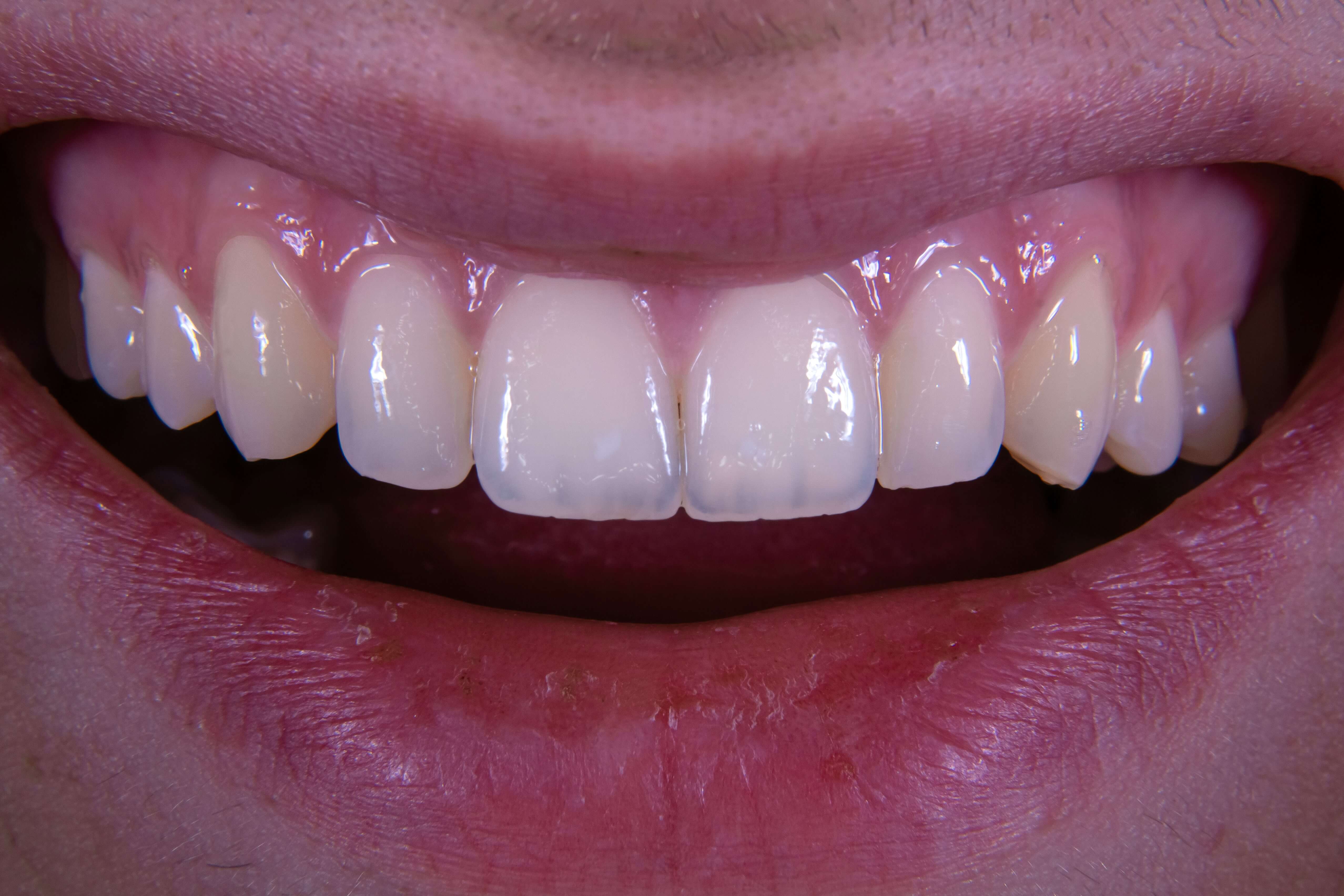 임플란트 시술과정