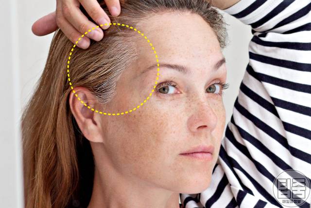 흰머리 나는 부위 고혈압 흰머리 부위별 원인