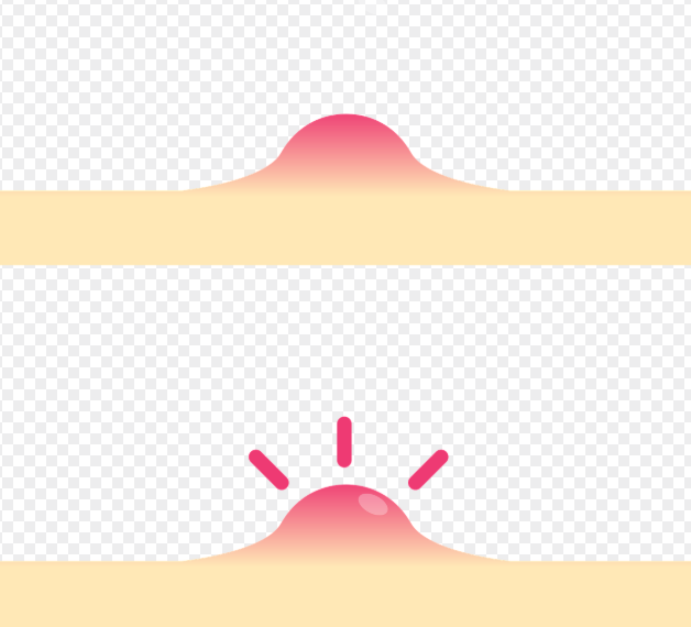 여드름 원인과 해결방법 총 정리 관련 사진