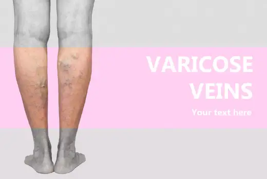 하지정맥류 초기 증상과 원인 치료방법