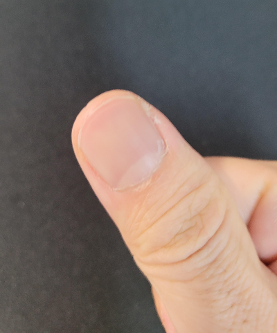 손톱 세로줄 생기는 이유