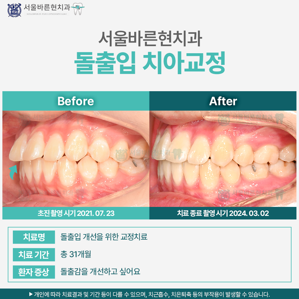 해운대치아교정