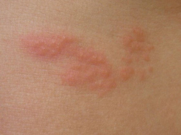 대상포진 초기증상 대상포진 조기치료 대상포진 초기증상 및 조기치료