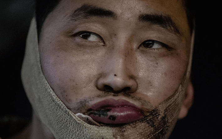 븍한국 포로 리씨 얼굴- 붕대로 얼굴을 싸매고 있다