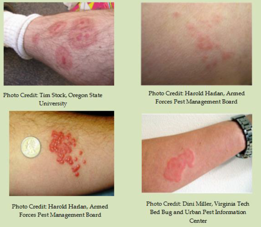 빈대에 무린 자국