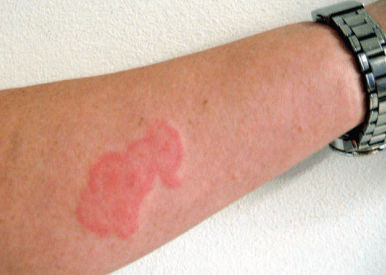 빈대 퇴치법과 효과적인 빈대 퇴치제