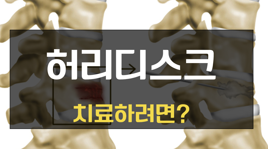 허리디스크 치료법