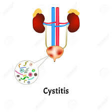 여성 방광염 증상