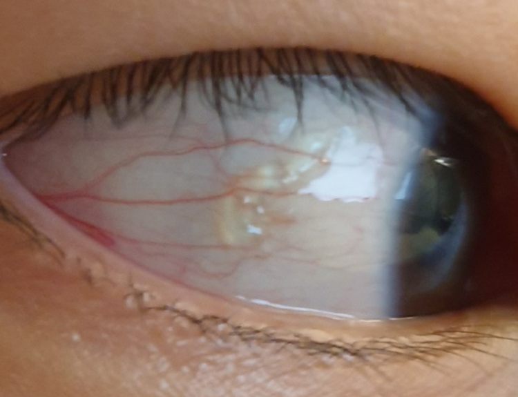 눈 흰자에 생긴 물집