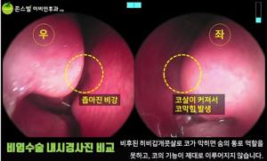 축농증수술