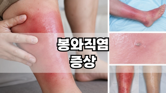 봉와직염 증상