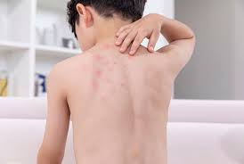 온몸이 가려운 증상